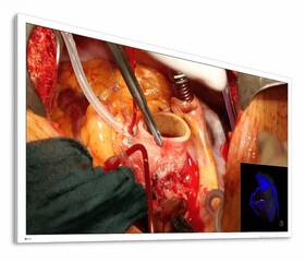 Eizo Ex5841 Curator 58 Inch Ultra Hd 4k Led Surgical Display